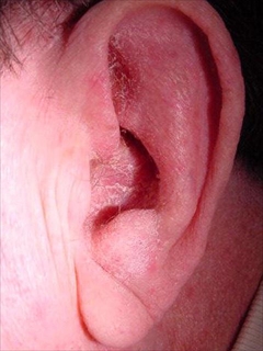 脂漏性皮膚炎による耳垢の例②