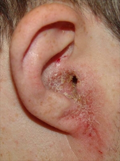 脂漏性皮膚炎による耳垢の例①